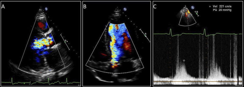 Pulsation of catheter during coronary angiography: Is it a sign of severe aortic regurgitation?