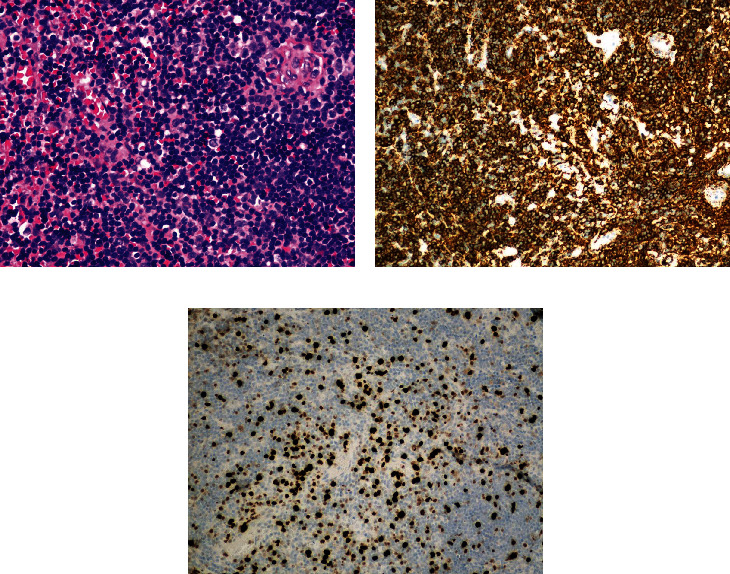 Primary Dural Lymphoma Mimicking En Plaque Cerebellopontine Angle Meningioma.