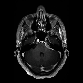 Primary Dural Lymphoma Mimicking En Plaque Cerebellopontine Angle Meningioma.