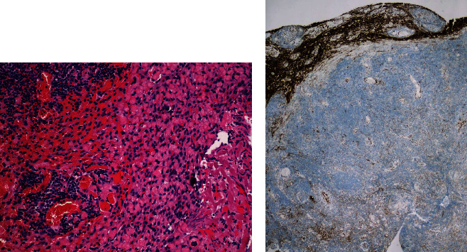 Primary Dural Lymphoma Mimicking En Plaque Cerebellopontine Angle Meningioma.