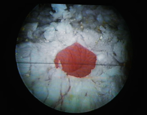 Diffuse Leukoplakia of the Bladder Ostium-Sparing in Patient Treated with Leuprorelin for Breast Cancer.