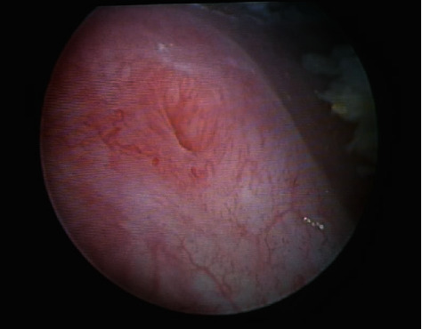 Diffuse Leukoplakia of the Bladder Ostium-Sparing in Patient Treated with Leuprorelin for Breast Cancer.