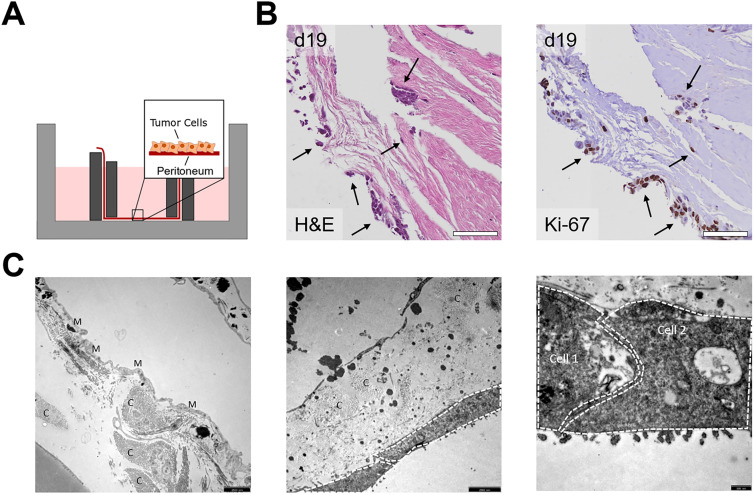 A human <i>ex vivo</i> coculture model to investigate peritoneal metastasis and innovative treatment options.
