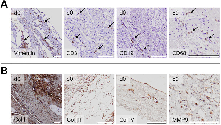 A human <i>ex vivo</i> coculture model to investigate peritoneal metastasis and innovative treatment options.