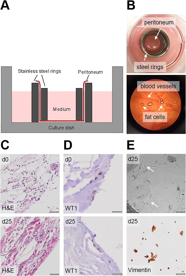 A human <i>ex vivo</i> coculture model to investigate peritoneal metastasis and innovative treatment options.