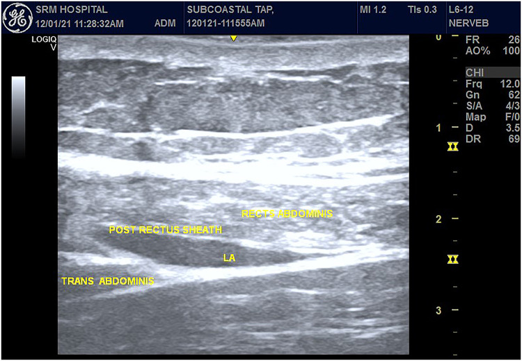 Comparison of Ultrasound-Guided Modified BRILMA Block with Subcostal Transversus Abdominis Plane Block for Postoperative Analgesia in Laparoscopic Cholecystectomy - A Randomized Controlled Trial.