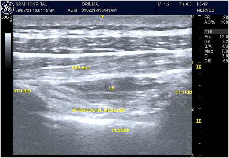 Comparison of Ultrasound-Guided Modified BRILMA Block with Subcostal Transversus Abdominis Plane Block for Postoperative Analgesia in Laparoscopic Cholecystectomy - A Randomized Controlled Trial.