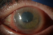 Acute anterior uveitis after topical interferon for conjunctival intraepithelial neoplasia (CIN).