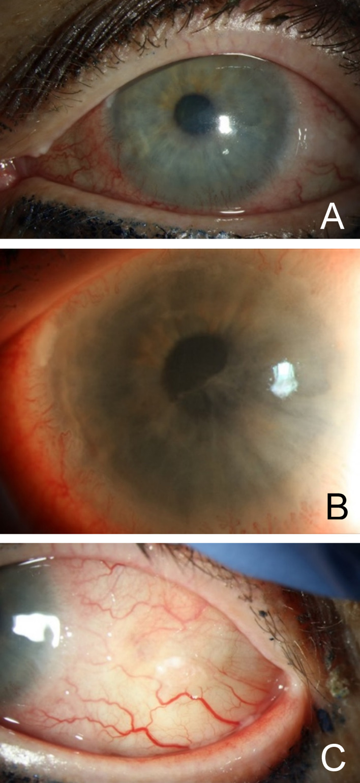 Acute anterior uveitis after topical interferon for conjunctival intraepithelial neoplasia (CIN).