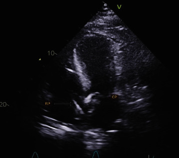 Biventricular Impella (Bi-Pella) in Refractory Cardiogenic Shock: The First Case from the Middle East.