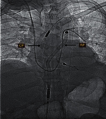 Biventricular Impella (Bi-Pella) in Refractory Cardiogenic Shock: The First Case from the Middle East.