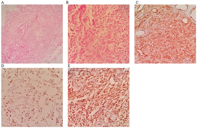 Clinicopathologic and Immunohistochemical Characteristics of Solitary Fibrous Tumor and Its Mimics: A Single-Center Experience.