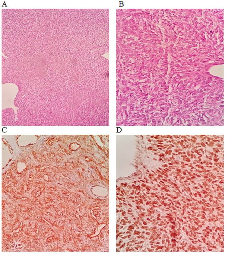 Clinicopathologic and Immunohistochemical Characteristics of Solitary Fibrous Tumor and Its Mimics: A Single-Center Experience.