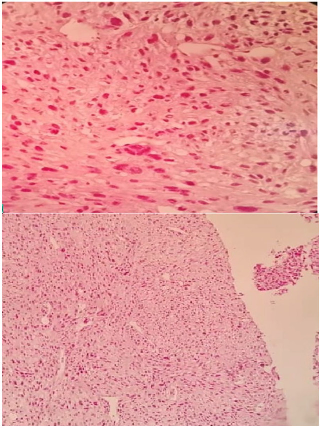 Clinicopathologic and Immunohistochemical Characteristics of Solitary Fibrous Tumor and Its Mimics: A Single-Center Experience.