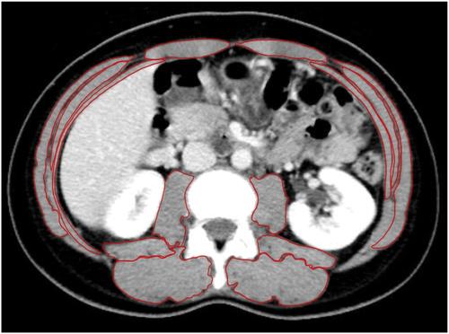 The relationship between evolving sarcopenia and efficacy of immune checkpoint inhibitor in non-small cell lung cancer patients