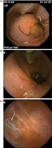 Iron deficiency anaemia and lower abdominal pain in a patient with resected Meckel's diverticulum