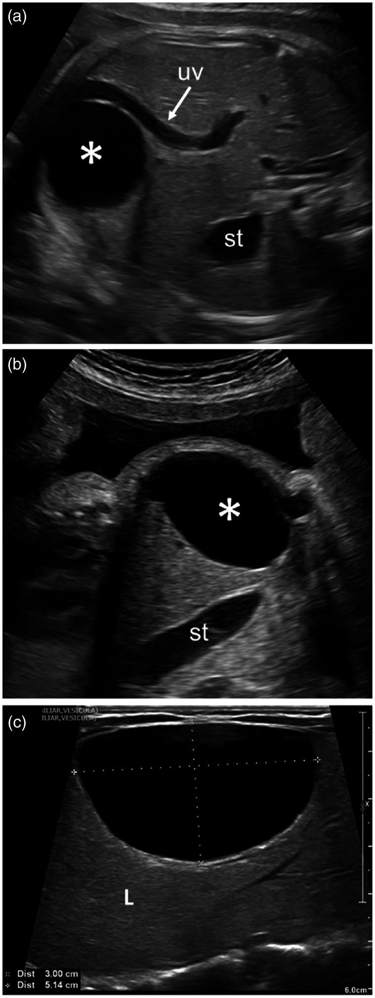 Congenital hepatic cyst: Prenatal and postnatal imaging findings.