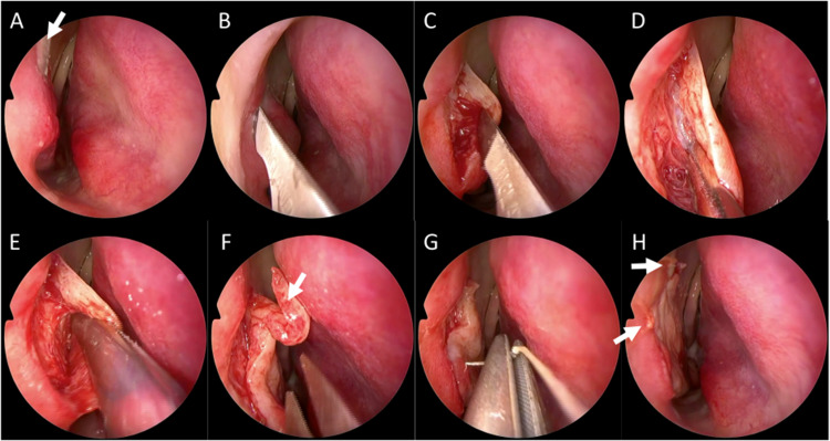 How I Do It: Inferior Turbinectomy: Modified Techniques for Submucosal Resection.