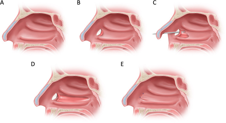 How I Do It: Inferior Turbinectomy: Modified Techniques for Submucosal Resection.