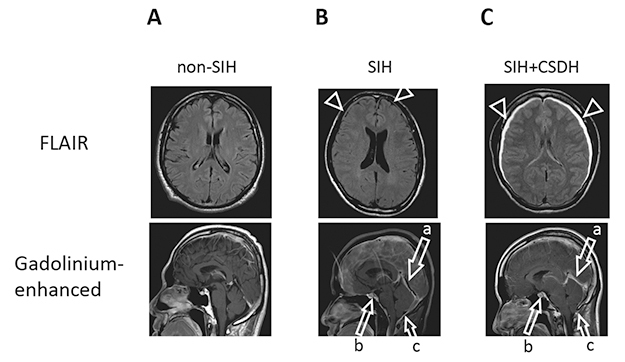 Total transferrin in cerebrospinal fluid is a novel biomarker for spontaneous intracranial hypotension.