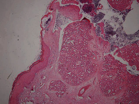 Vulvar Pyogenic Granuloma in Adult Female Population: A Case Report and Review of the Literature.