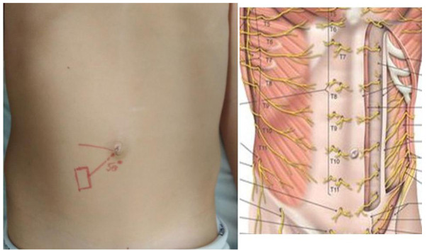 [Anterior cutaneous nerve entrapment syndrome: a frequently overlooked cause of chronic abdominal pain in children].