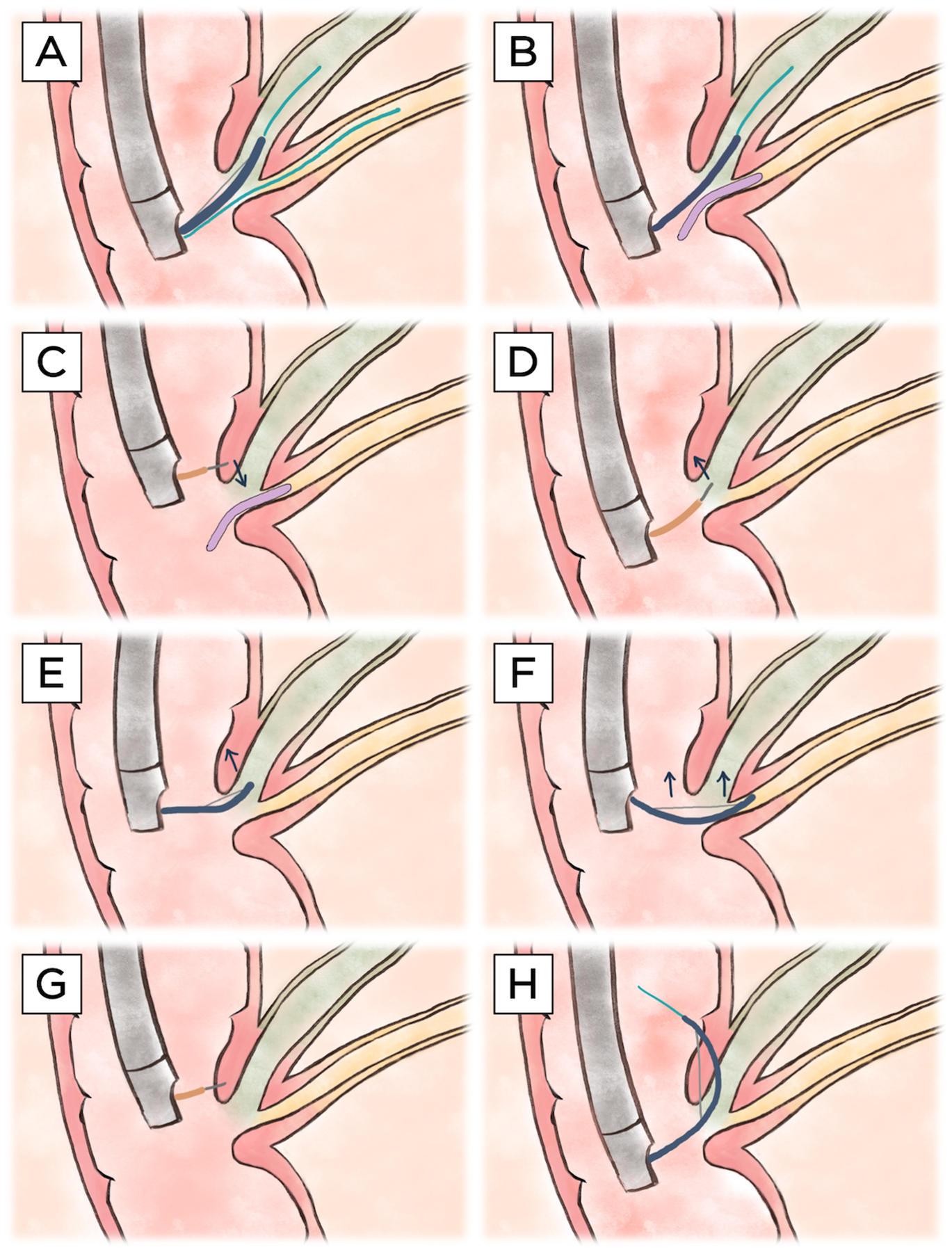 Difficult Biliary Cannulation in Endoscopic Retrograde Cholangiopancreatography: An Overview of Advanced Techniques.