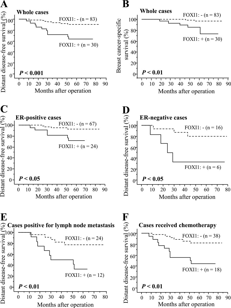 Forkhead Box I1 in Breast Carcinoma as a Potent Prognostic Factor.