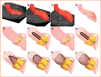 Patient-specific Computer Simulation: An Emerging Technology for Guiding the Transcatheter Treatment of Patients with Bicuspid Aortic Valve.