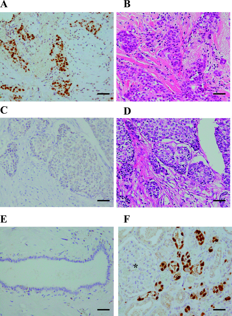 Forkhead Box I1 in Breast Carcinoma as a Potent Prognostic Factor.