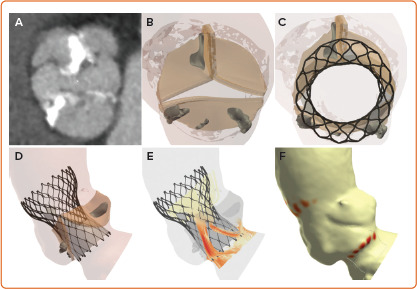 Patient-specific Computer Simulation: An Emerging Technology for Guiding the Transcatheter Treatment of Patients with Bicuspid Aortic Valve.
