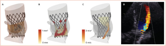 Patient-specific Computer Simulation: An Emerging Technology for Guiding the Transcatheter Treatment of Patients with Bicuspid Aortic Valve.