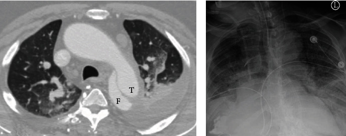 Positive Retrospective SARS-CoV-2 Testing in a Case of Acute Respiratory Distress Syndrome of Unknown Etiology.