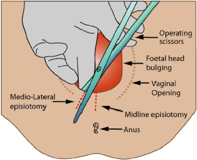 Ignoring international alerts? The routinization of episiotomy in France in the 1980s and 1990s