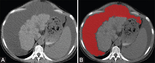 Computed tomography in the diagnosis of intraperitoneal effusions: The role of texture analysis.