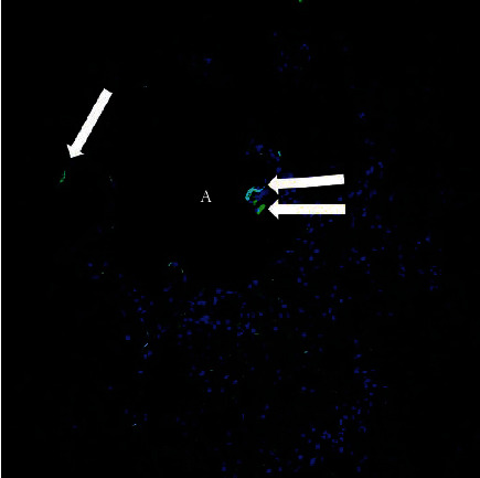 Positive Retrospective SARS-CoV-2 Testing in a Case of Acute Respiratory Distress Syndrome of Unknown Etiology.