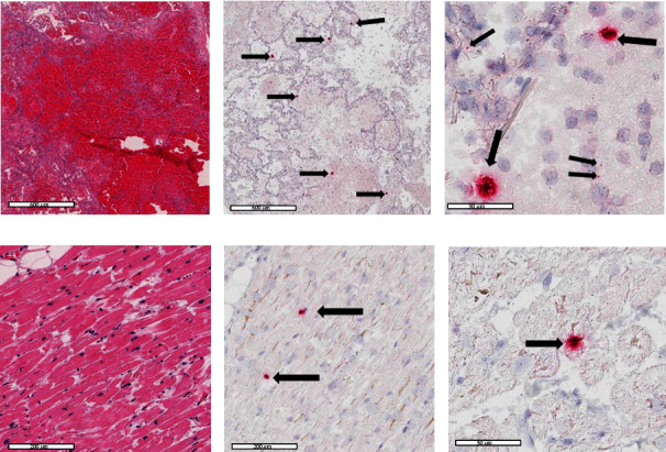 Positive Retrospective SARS-CoV-2 Testing in a Case of Acute Respiratory Distress Syndrome of Unknown Etiology.