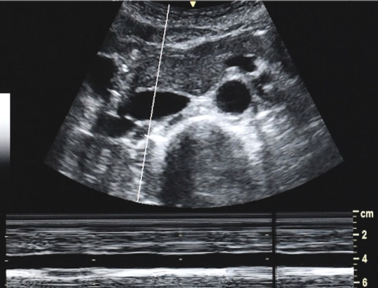 Sonographic Estimation Rather Than Quantification of Fluid Status Using Inferior Vena Cava and Other Major Vessel Parameters in a Non-Bleeding Fluid Loss and Centralization Model.