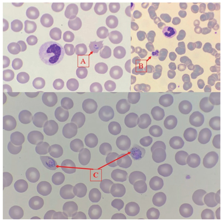 COVID-19 and Plasmodium ovale Malaria: A Rare Case of Co-Infection.