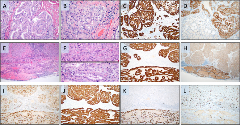 Development of metastatic poorly differentiated thyroid cancer from a sub-centimeter papillary thyroid carcinoma in a young patient with a germline MET mutation - association or random chance?