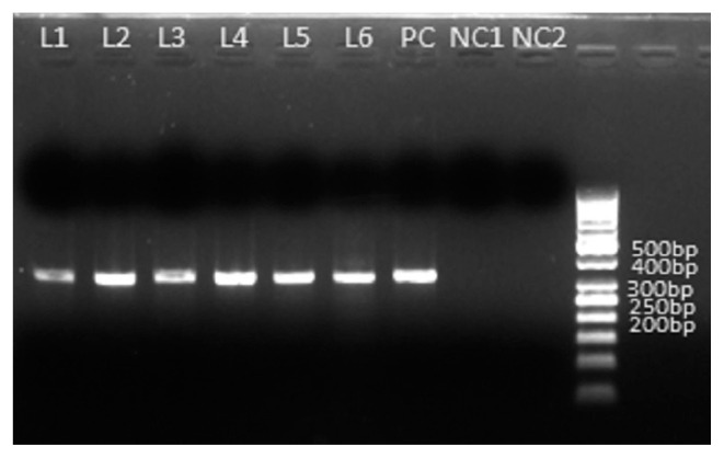 Molecular Identification of Cryptosporidium viatorum Infection in a Patient Suffering from Unusual Cryptosporidiosis in West Bengal, India.