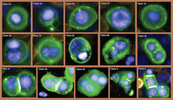 Circulating erythroblast abnormality associated with systemic pathologies may indicate bone marrow damage.