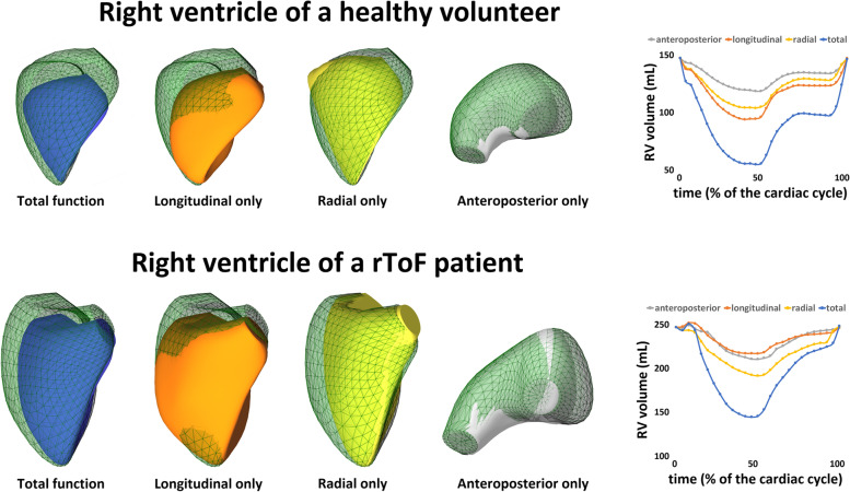 Global and regional right ventricular mechanics in repaired tetralogy of Fallot with chronic severe pulmonary regurgitation: a three-dimensional echocardiography study.