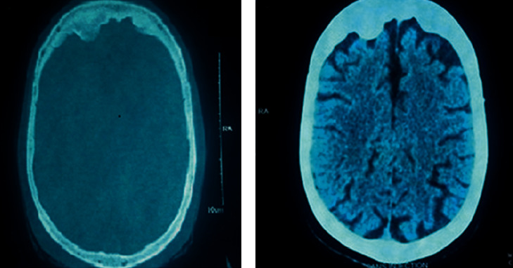 Schizophrenia and Hyperostosis Frontalis Interna with History of Head Injury.