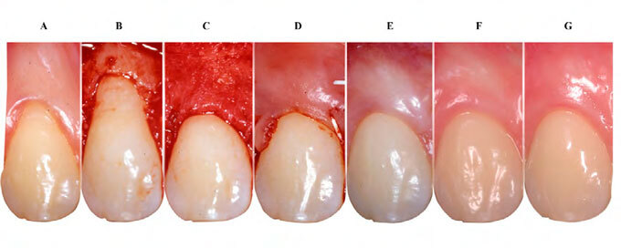 Clinical evaluation of root coverage using coronally positioned flap associated with acellular dermal matrix allograft in single-type recession defects. A retrospective study.