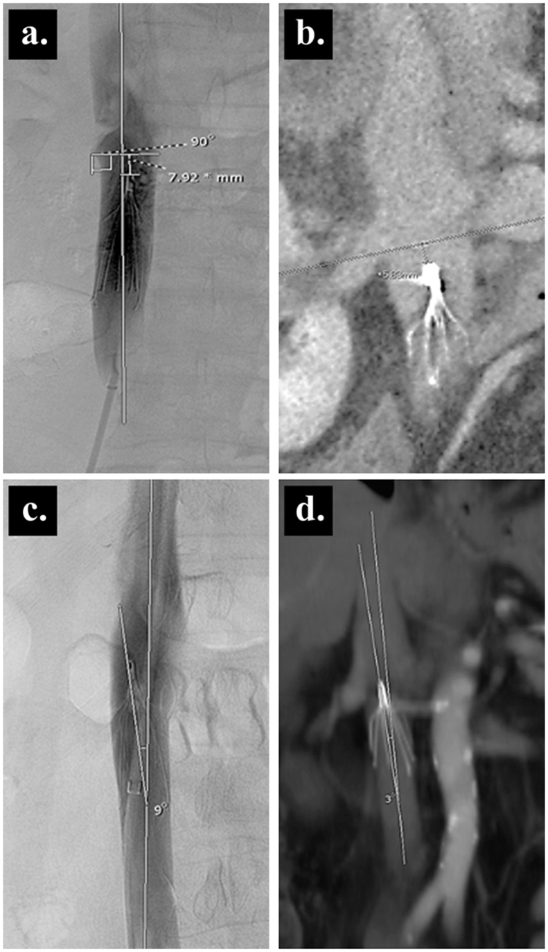 Comparative outcomes of Inferior Vena Cava filters placed at bedside using digital radiography versus conventional fluoroscopy