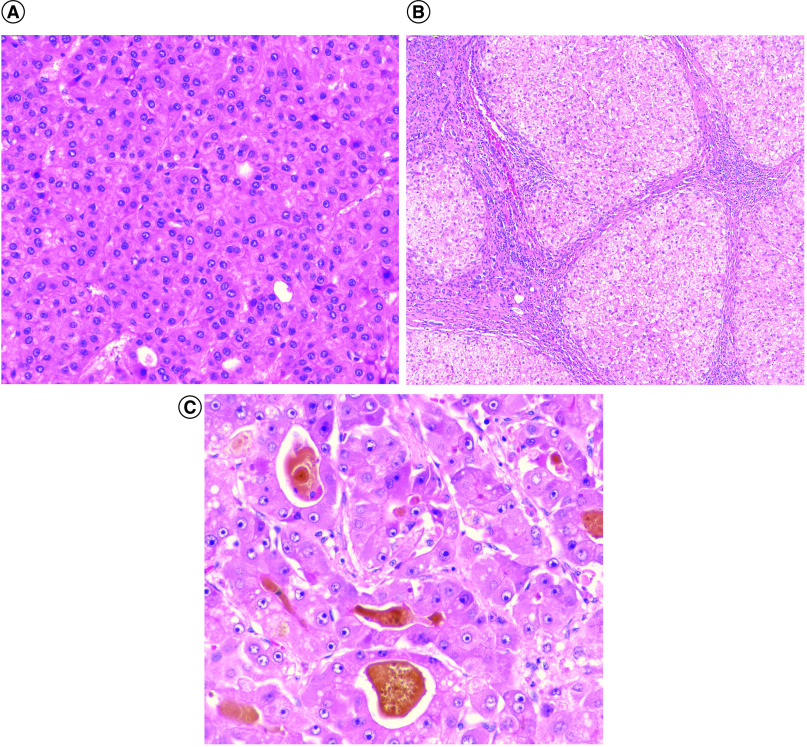 Evaluation of tumor mutational burden in small early hepatocellular carcinoma and progressed hepatocellular carcinoma.