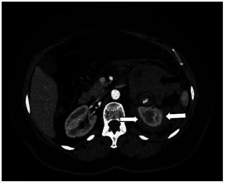 [Wünderlich syndrome: a case report].