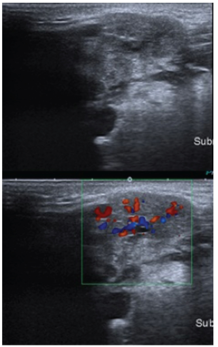 [Acute sialadenitis by iodine contrast medium administration].