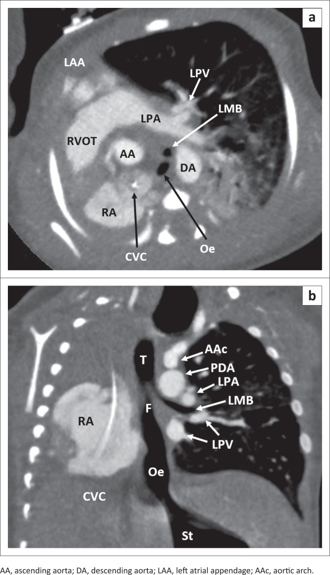 Unilateral opaque chest radiograph in paediatrics: A case series.